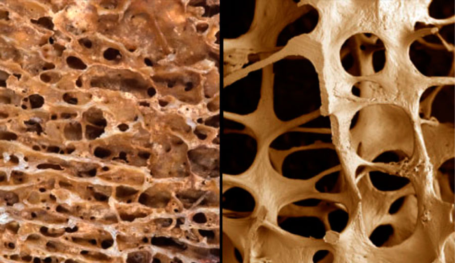 healthy bone and osteoporosis (osteoporotic bone)